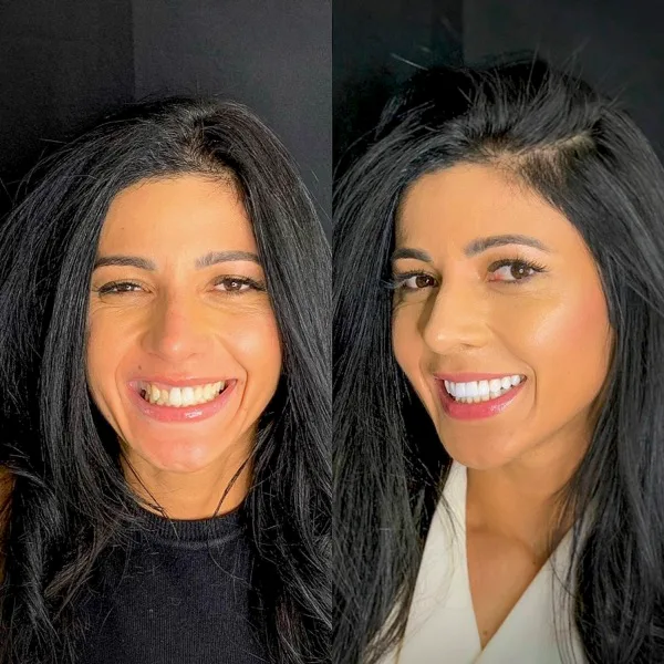 Juliana, paciente, antes e depois das lentes de contato dental